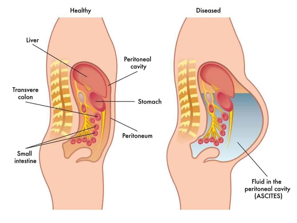 Homeopathic Treatments for Ascites Homeopathic Treatments for Ascites