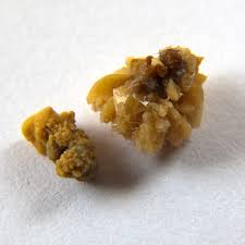 Calculi-Stones
