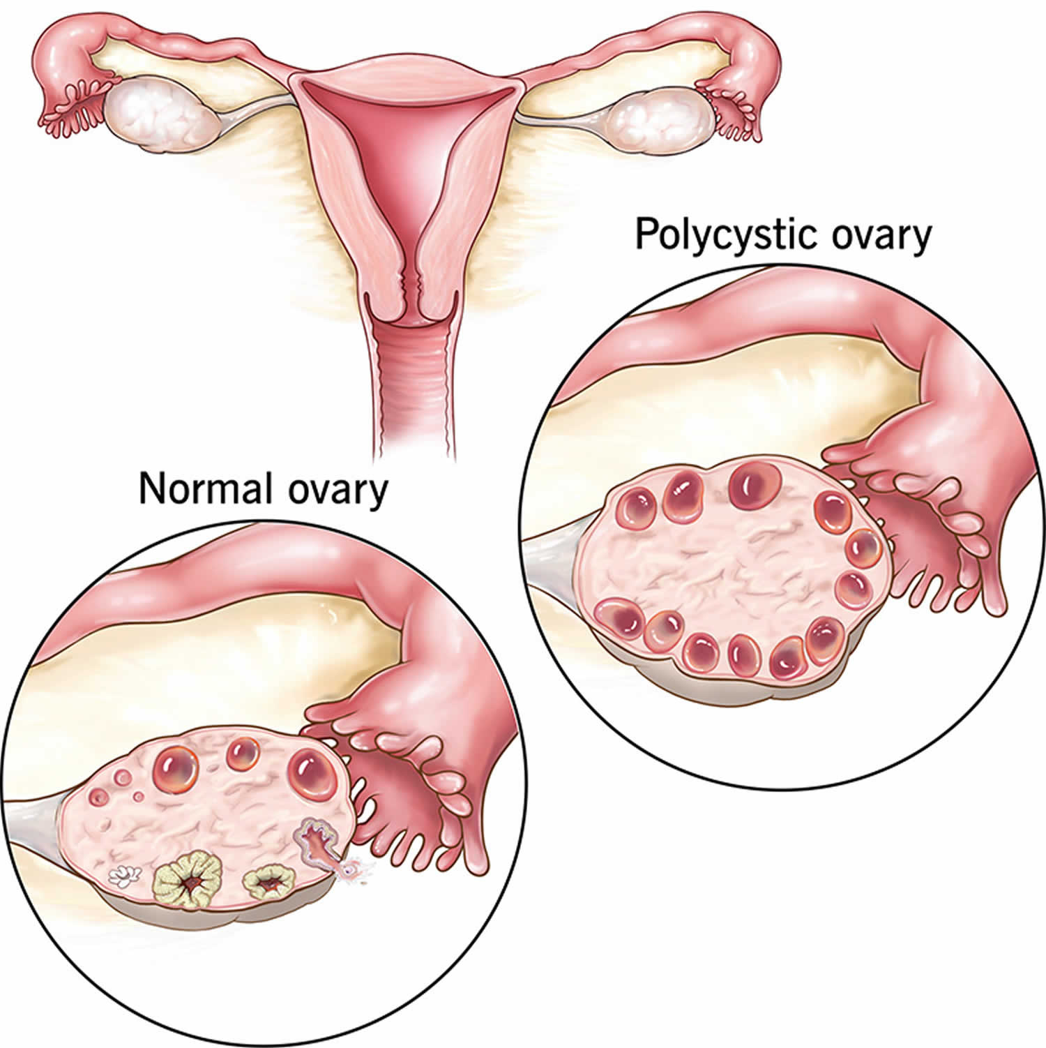 Homeopathic Treatment Polycystic Ovarian Syndrome (PCOS) Homeopathic Treatment Polycystic Ovarian Syndrome (PCOS)