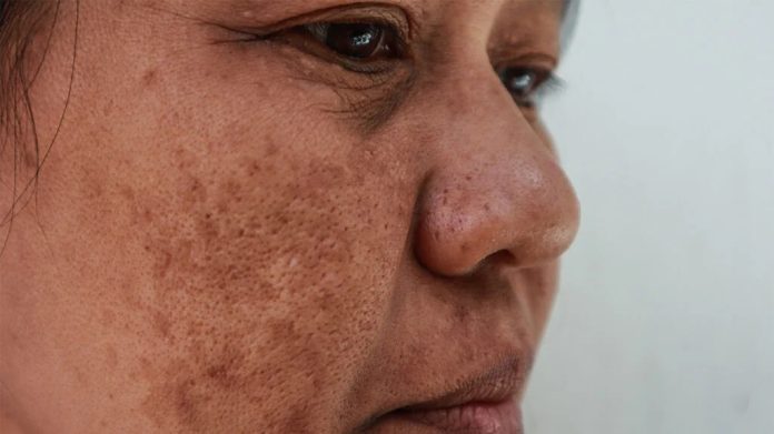 Melasma Homeopathic Medicine for Pigmentation